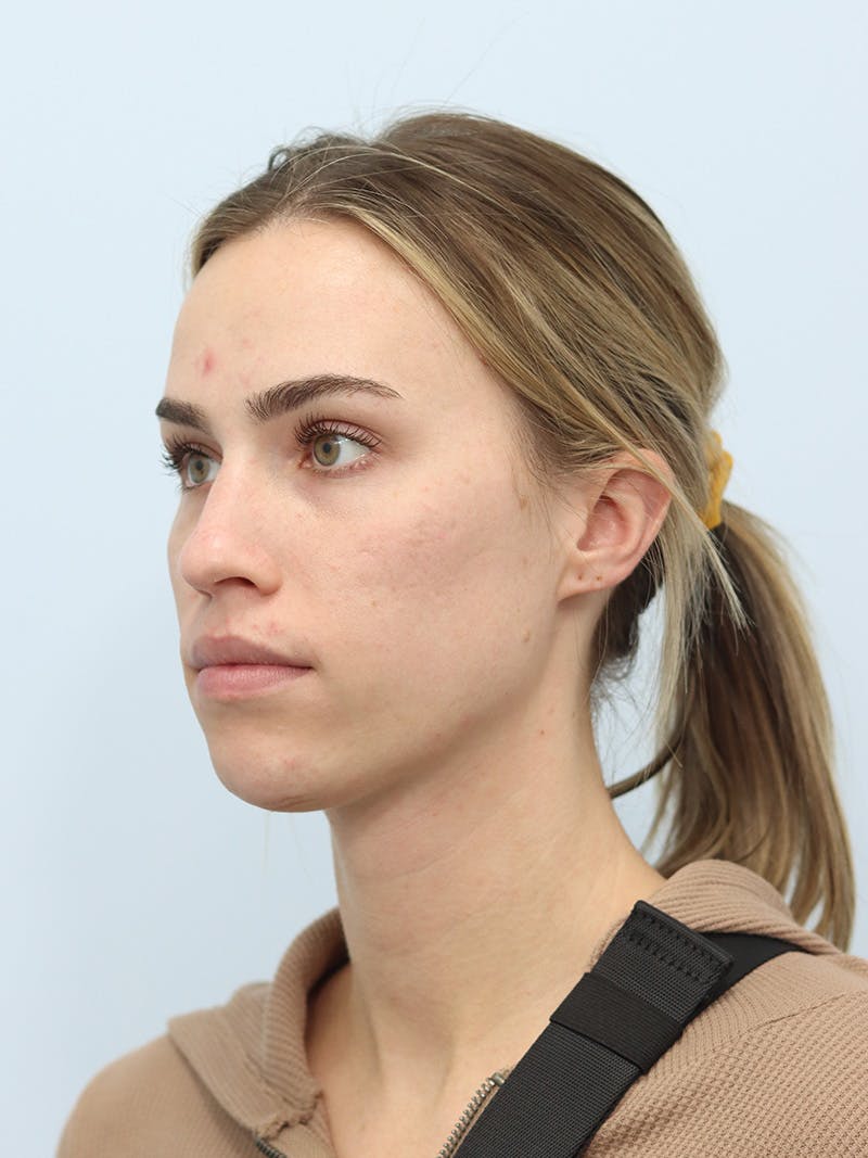 Facial Fat Transfer Before & After Gallery - Patient 425818 - Image 7