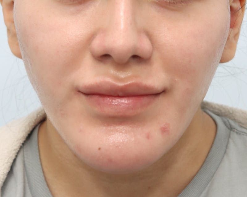 Rhinoplasty Before & After Gallery - Patient 327386 - Image 3