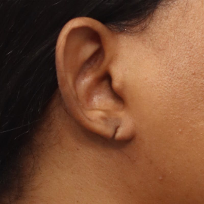 Earlobe Repair Before & After Gallery - Patient 200972 - Image 3