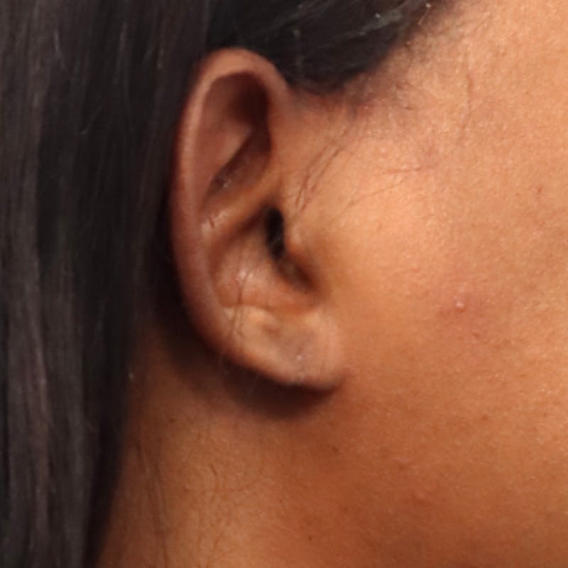 Earlobe Repair Before & After Gallery - Patient 200972 - Image 4