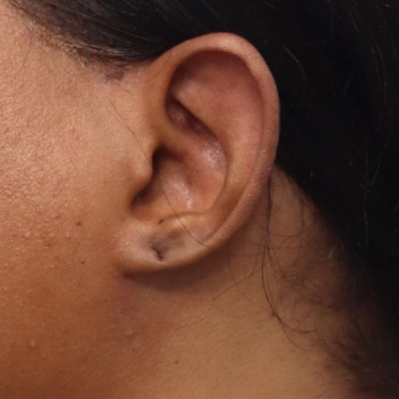 Earlobe Repair Before & After Gallery - Patient 200972 - Image 1