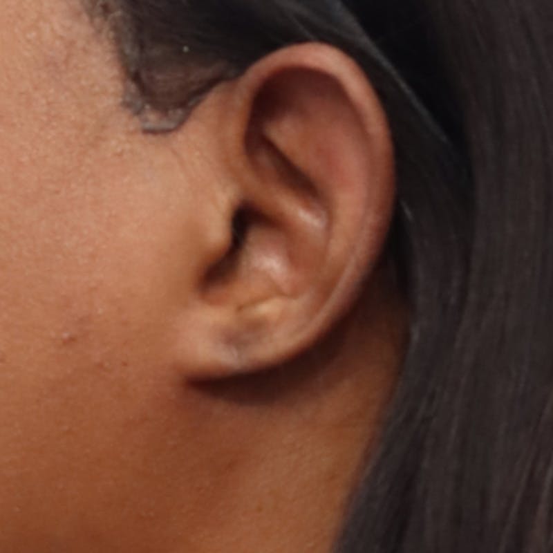 Earlobe Repair Before & After Gallery - Patient 200972 - Image 2