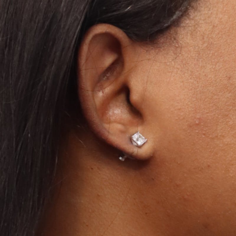 Earlobe Repair Before & After Gallery - Patient 200972 - Image 6