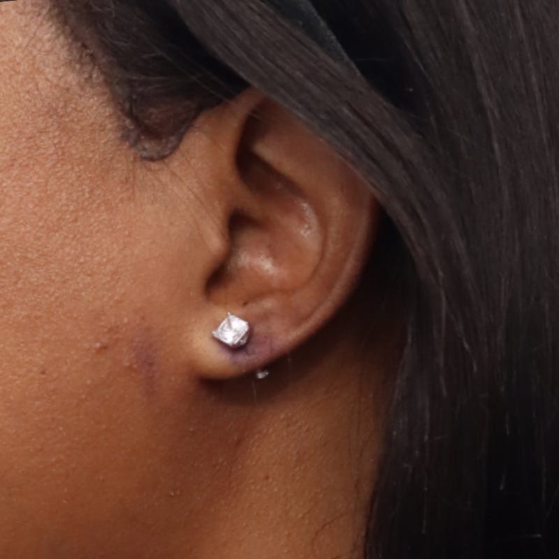 Earlobe Repair Before & After Gallery - Patient 200972 - Image 8