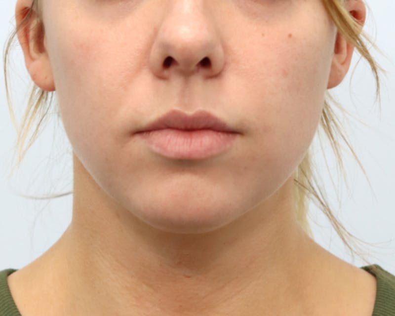 Neck Liposuction Before & After Gallery - Patient 376868 - Image 3