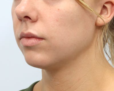 Neck Liposuction Before & After Gallery - Patient 376868 - Image 1