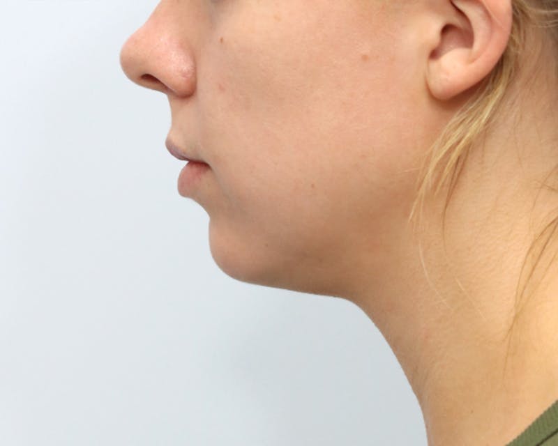 Neck Liposuction Before & After Gallery - Patient 376868 - Image 5