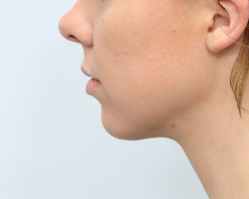 Neck Liposuction Before & After Gallery - Patient 376868 - Image 6