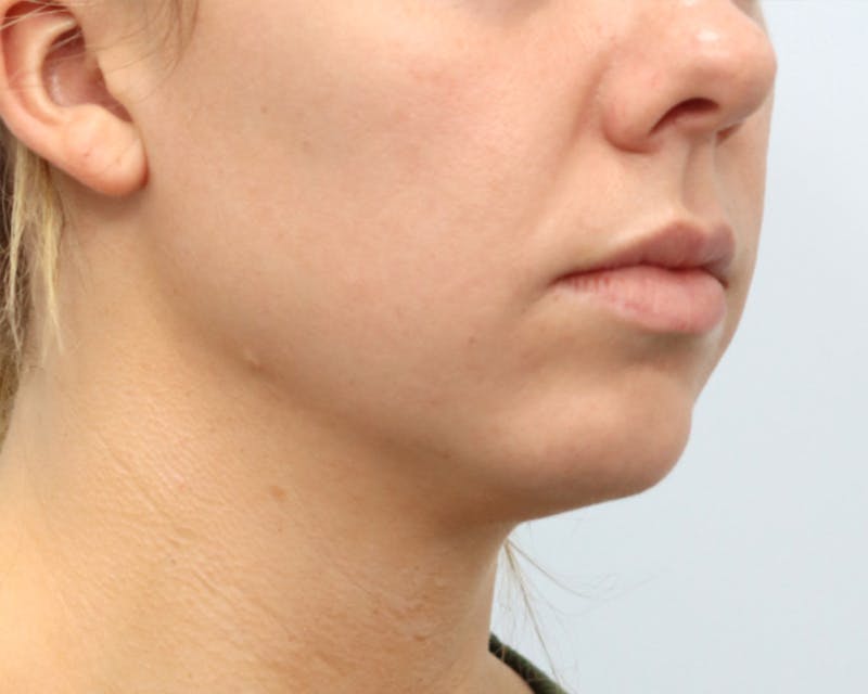 Neck Liposuction Before & After Gallery - Patient 376868 - Image 7