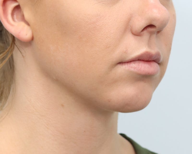 Neck Liposuction Before & After Gallery - Patient 376868 - Image 8