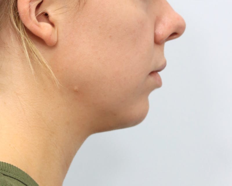 Neck Liposuction Before & After Gallery - Patient 376868 - Image 9