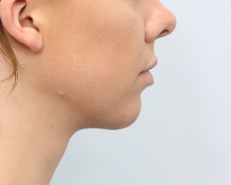 Neck Liposuction Before & After Gallery - Patient 376868 - Image 10