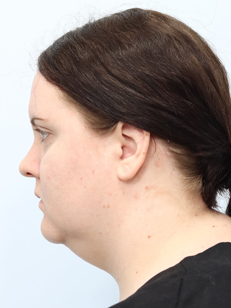 Neck Liposuction Before & After Gallery - Patient 267710 - Image 3