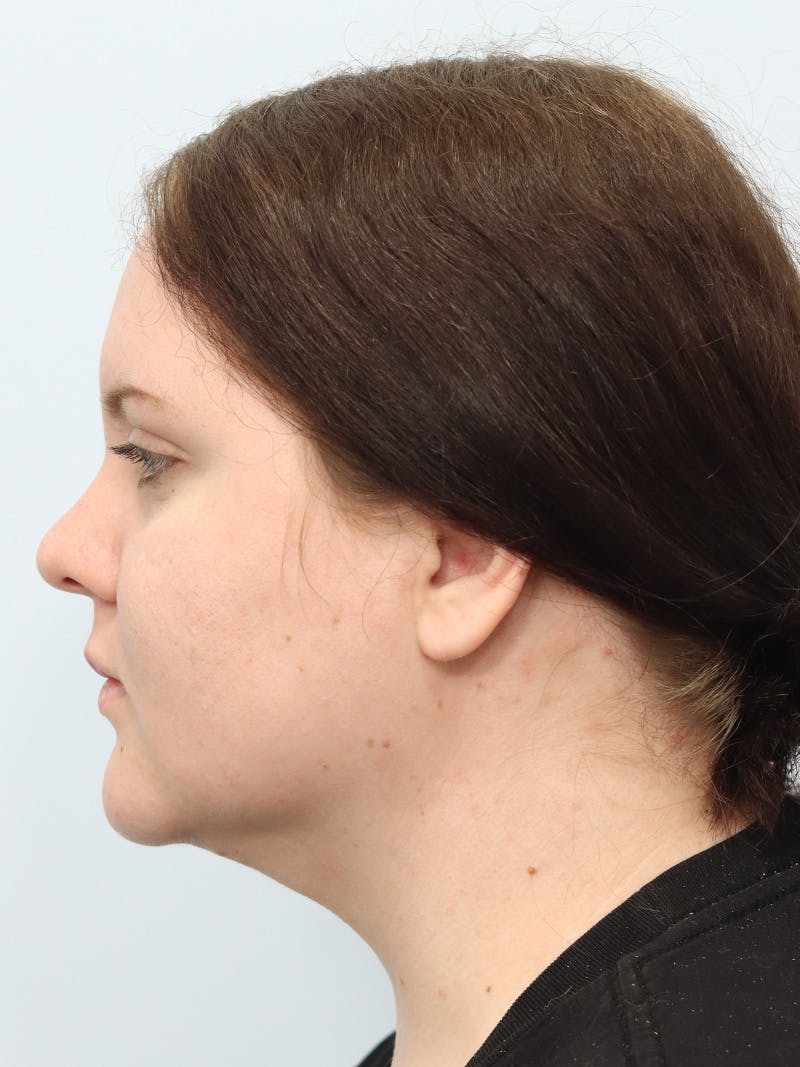 Neck Liposuction Before & After Gallery - Patient 267710 - Image 4