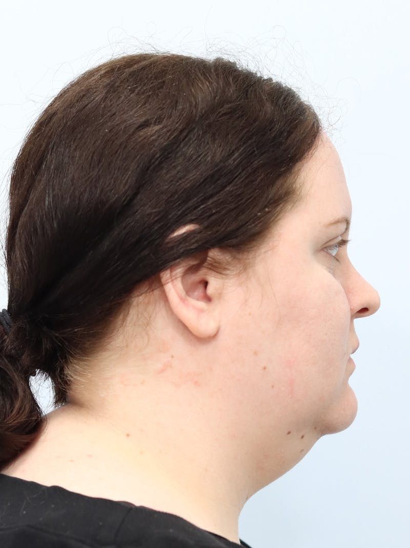 Neck Liposuction Before & After Gallery - Patient 267710 - Image 9