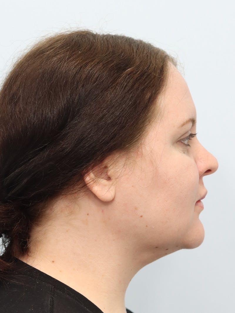 Neck Liposuction Before & After Gallery - Patient 267710 - Image 10