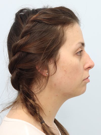 Chin Implant Before & After Gallery - Patient 121466 - Image 1