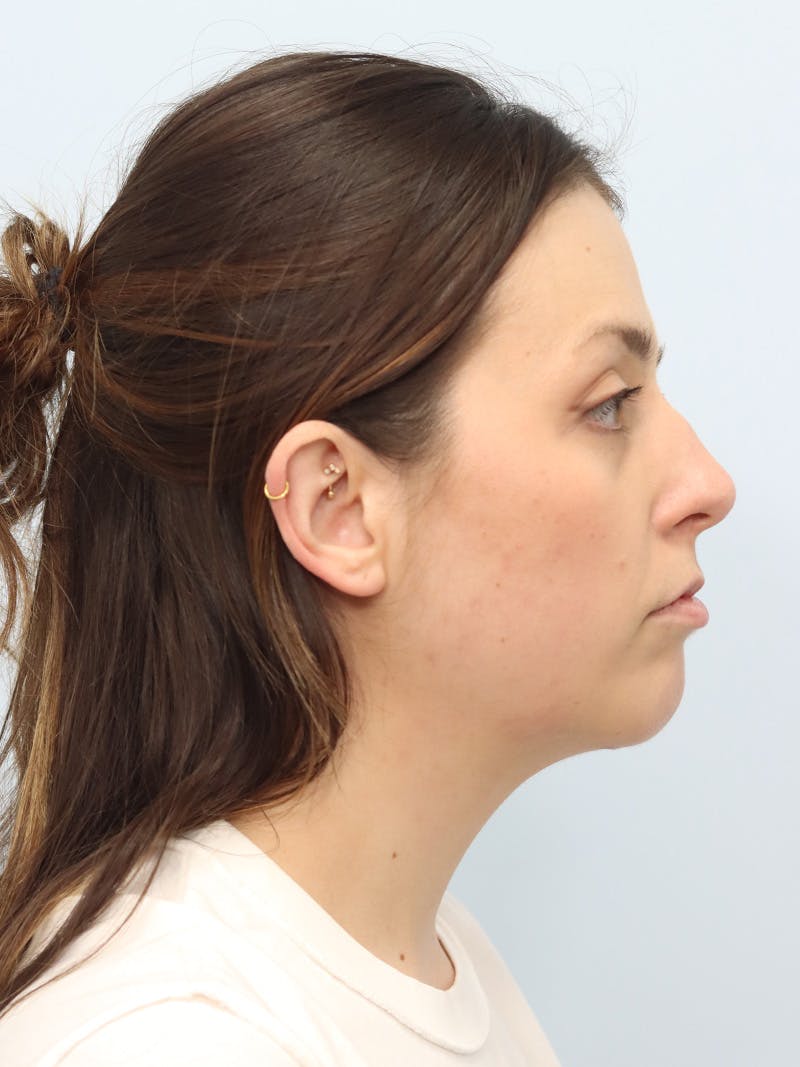 Chin Implant Before & After Gallery - Patient 121466 - Image 2