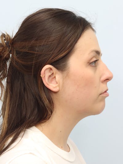 Chin Implant Before & After Gallery - Patient 121466 - Image 2