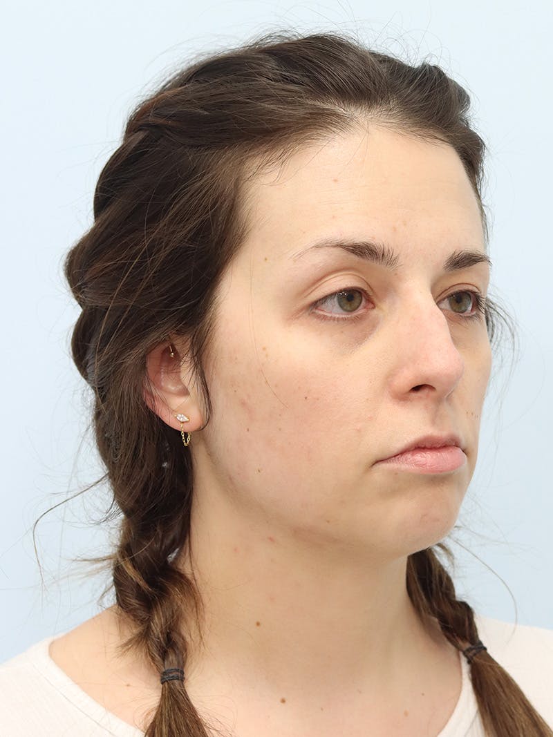 Chin Implant Before & After Gallery - Patient 121466 - Image 3