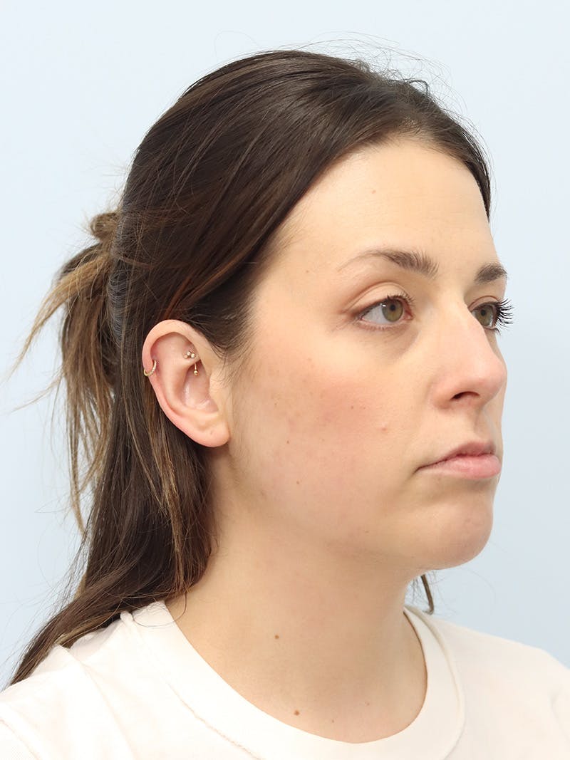 Chin Implant Before & After Gallery - Patient 121466 - Image 4