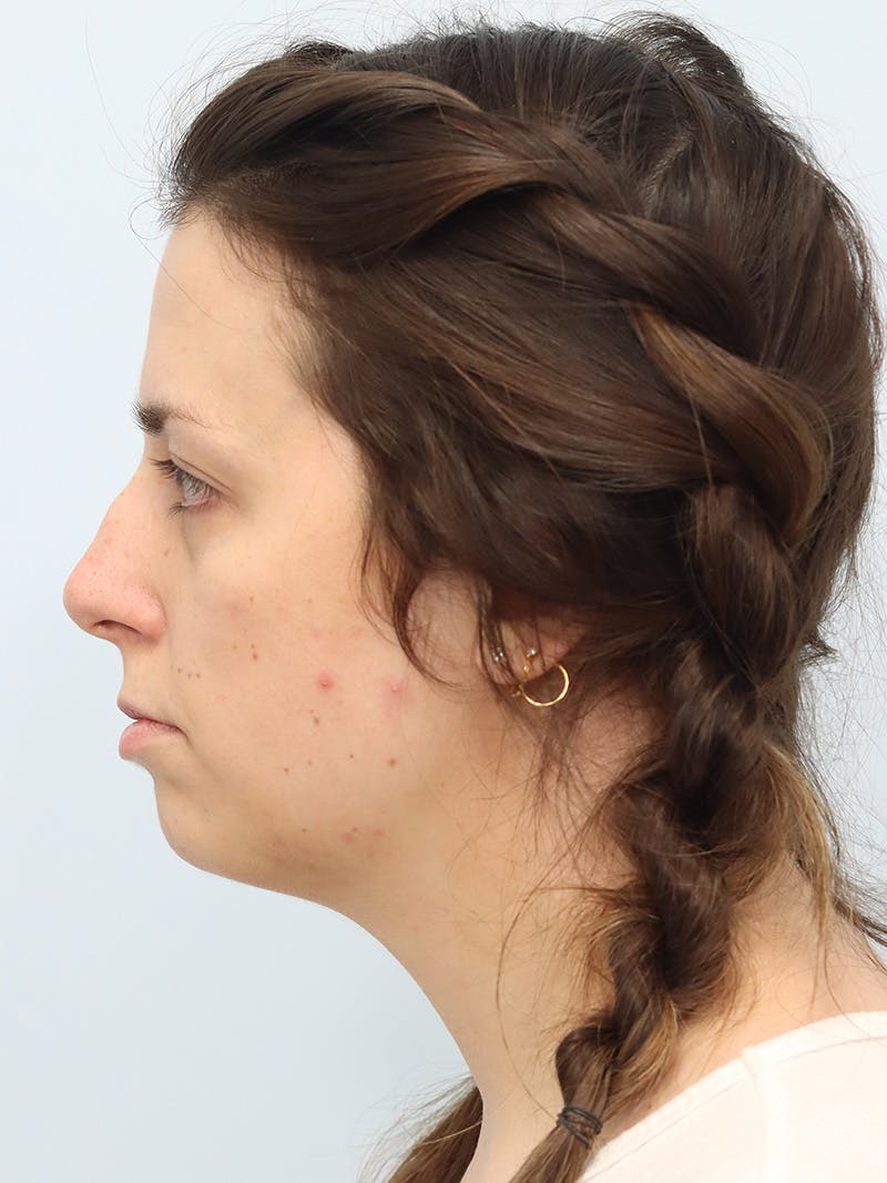 Chin Implant Before & After Gallery - Patient 121466 - Image 7