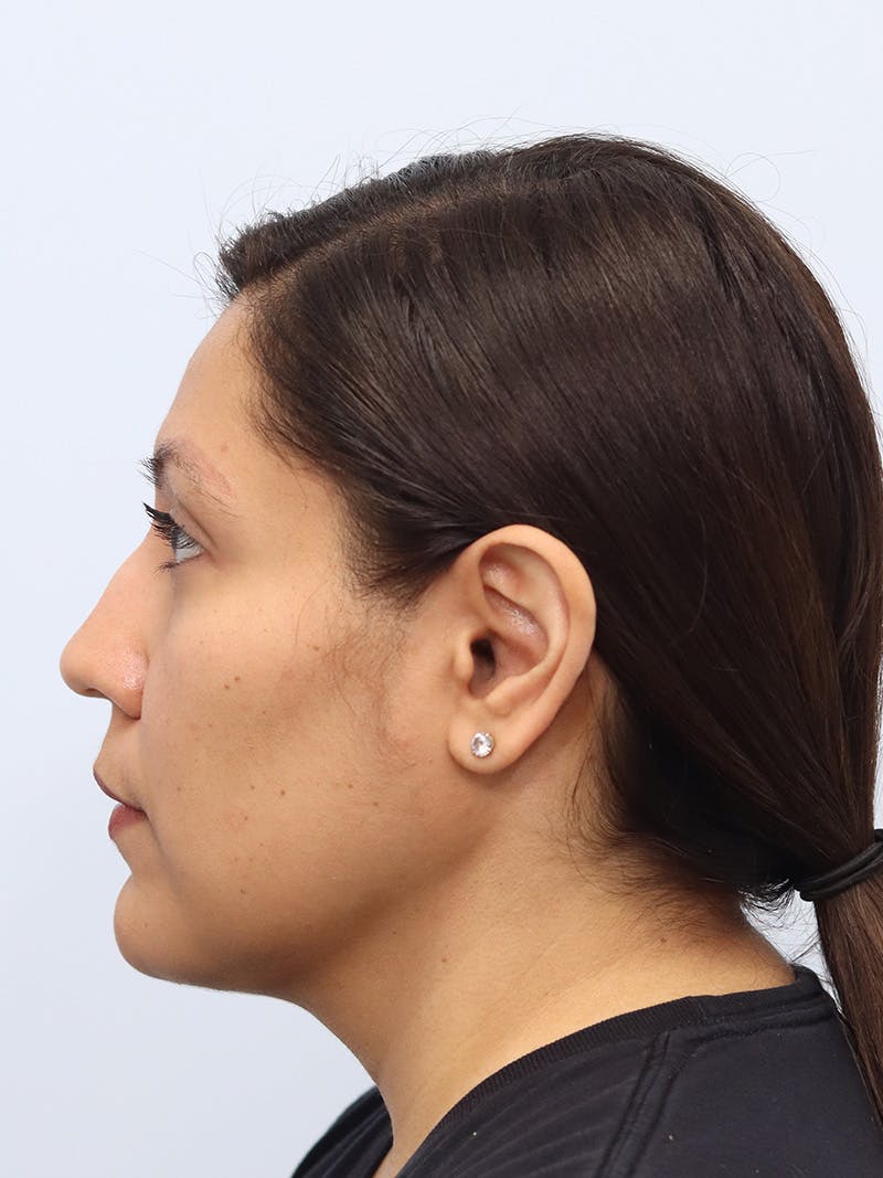 Neck Liposuction Before & After Gallery - Patient 147644157 - Image 4