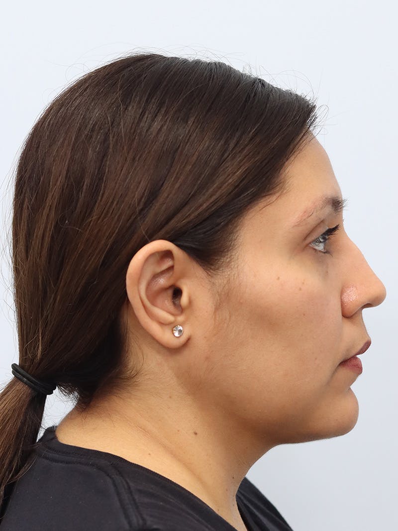 Neck Liposuction Before & After Gallery - Patient 147644157 - Image 10