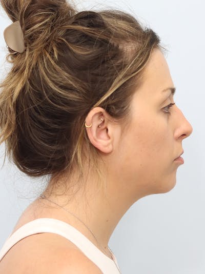 Chin Implant Before & After Gallery - Patient 121466 - Image 2