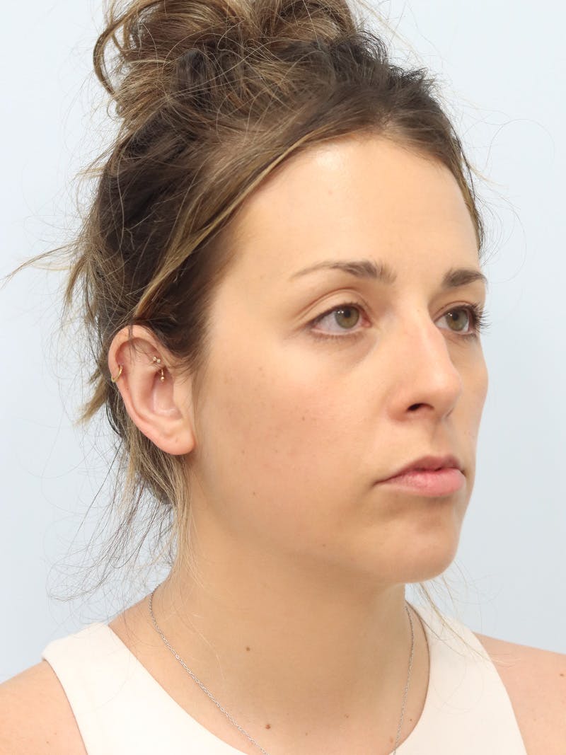 Chin Implant Before & After Gallery - Patient 121466 - Image 4