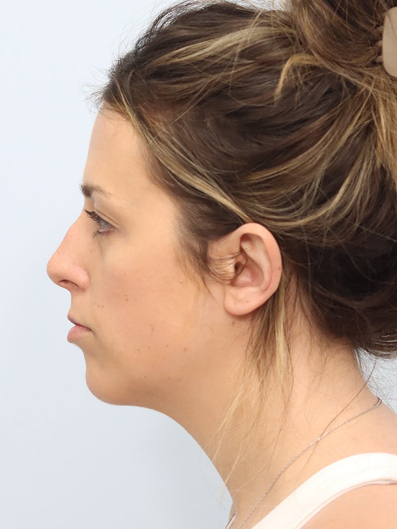 Chin Implant Before & After Gallery - Patient 121466 - Image 8