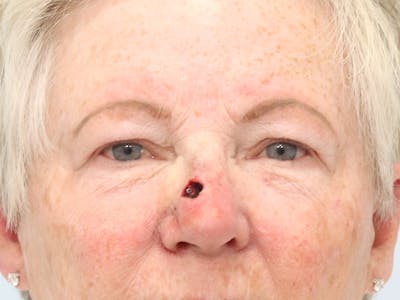 Reconstructive Before & After Gallery - Patient 245186 - Image 1