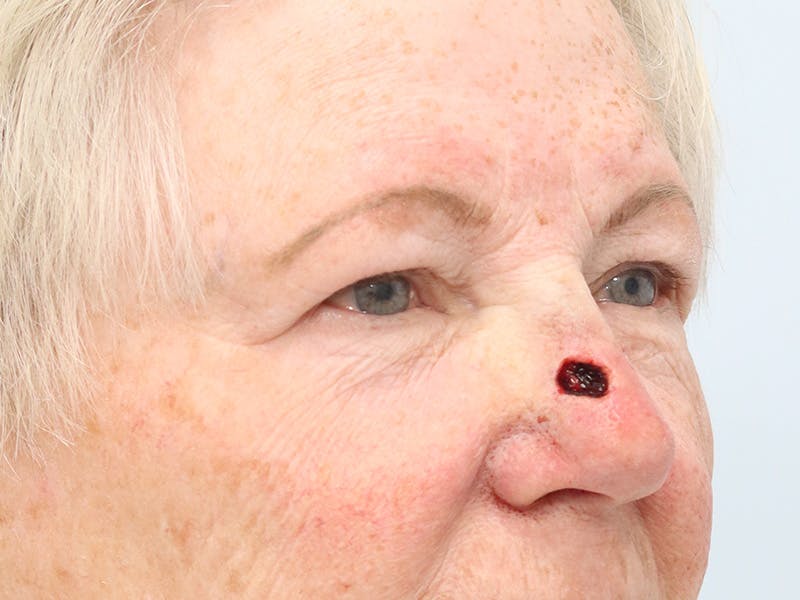 Reconstructive Before & After Gallery - Patient 245186 - Image 3