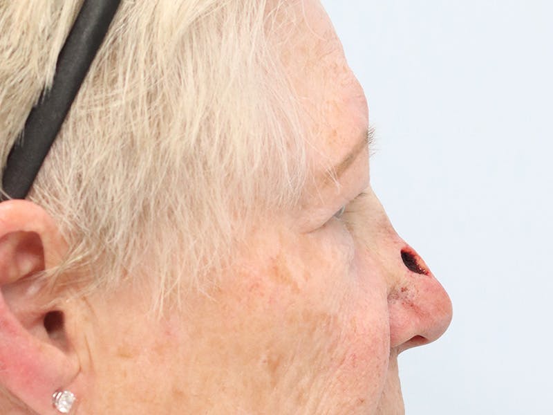Reconstructive Before & After Gallery - Patient 245186 - Image 5