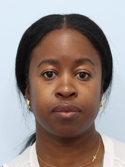 Microneedling Before & After Gallery - Patient 307116 - Image 1