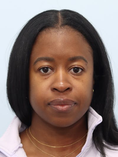 Microneedling Before & After Gallery - Patient 307116 - Image 2