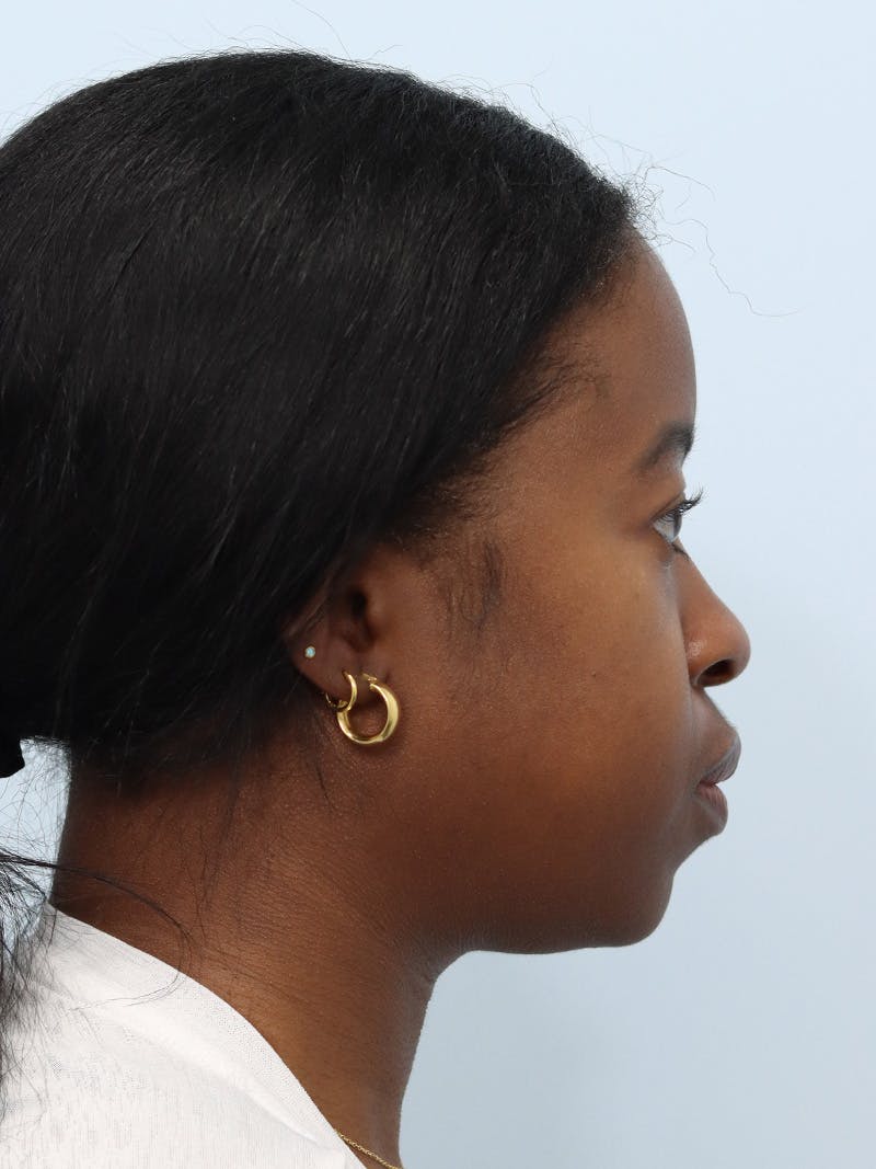 Microneedling Before & After Gallery - Patient 307116 - Image 9