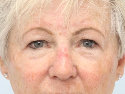 Reconstructive Before & After Gallery - Patient 245186 - Image 2