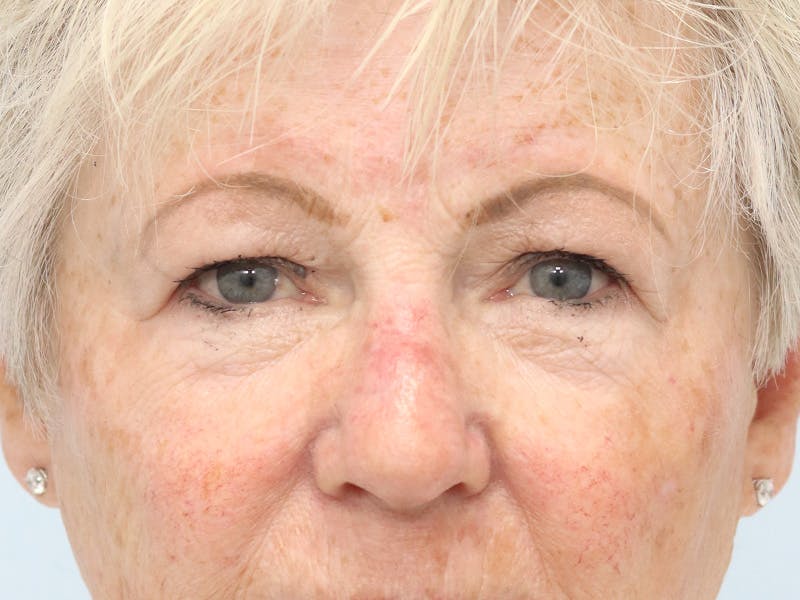 Reconstructive Before & After Gallery - Patient 245186 - Image 2