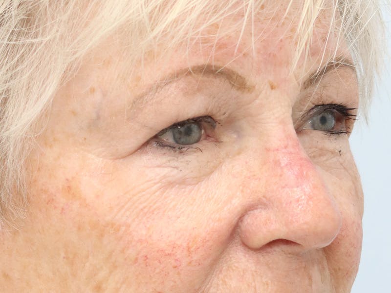 Reconstructive Before & After Gallery - Patient 245186 - Image 4