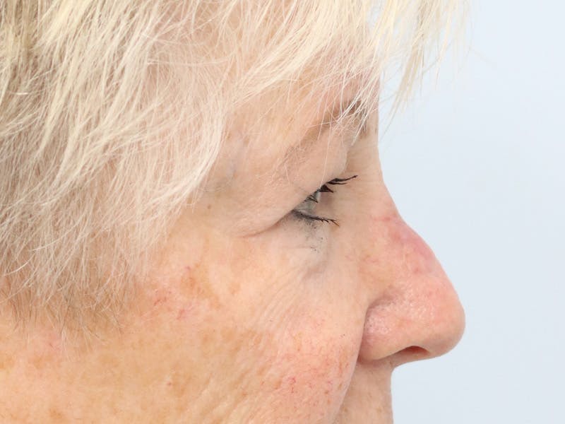 Reconstructive Before & After Gallery - Patient 245186 - Image 6