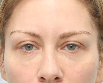 Blepharoplasty Before & After Gallery - Patient 316123 - Image 1