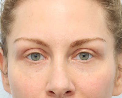 Blepharoplasty Before & After Gallery - Patient 316123 - Image 2