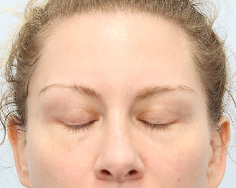 Blepharoplasty Before & After Gallery - Patient 316123 - Image 3