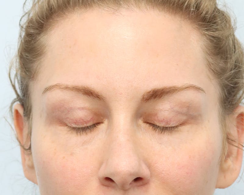 Blepharoplasty Before & After Gallery - Patient 316123 - Image 4