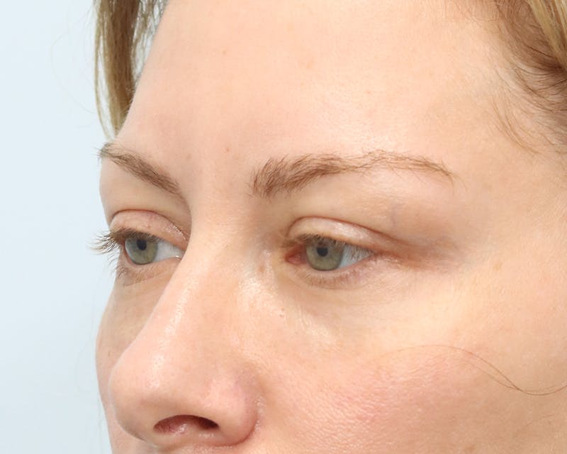 Blepharoplasty Before & After Gallery - Patient 316123 - Image 5