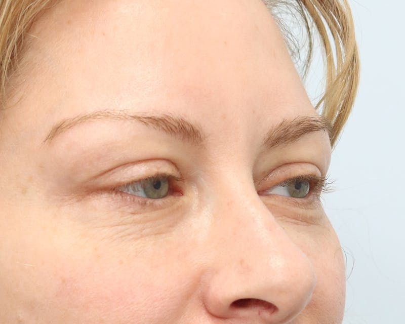 Blepharoplasty Before & After Gallery - Patient 316123 - Image 7