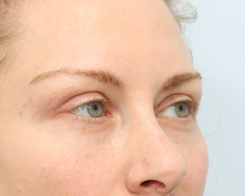 Blepharoplasty Before & After Gallery - Patient 316123 - Image 8