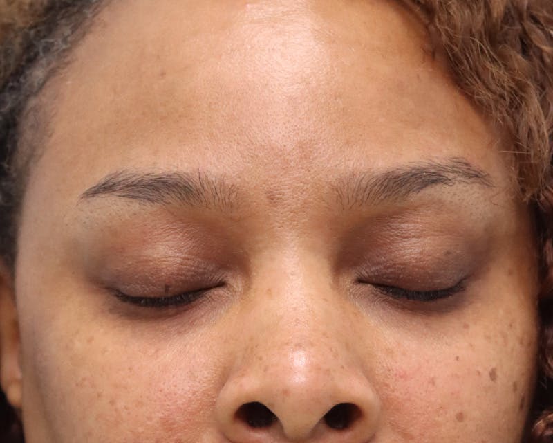 Blepharoplasty Before & After Gallery - Patient 426712 - Image 3