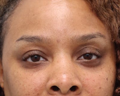 Blepharoplasty Before & After Gallery - Patient 426712 - Image 1